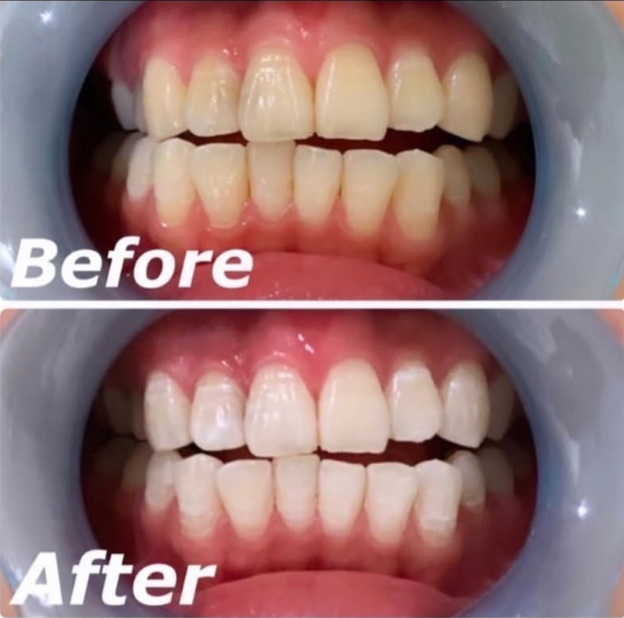 ホワイトニング